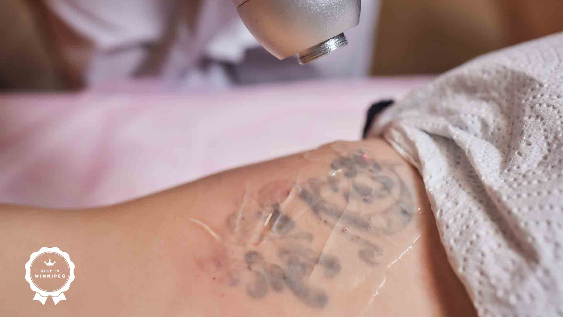 Best Tattoo Removal Services in Winnipeg