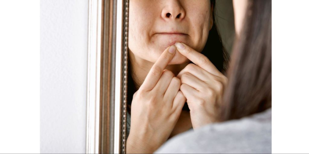 Acne Scar Causes