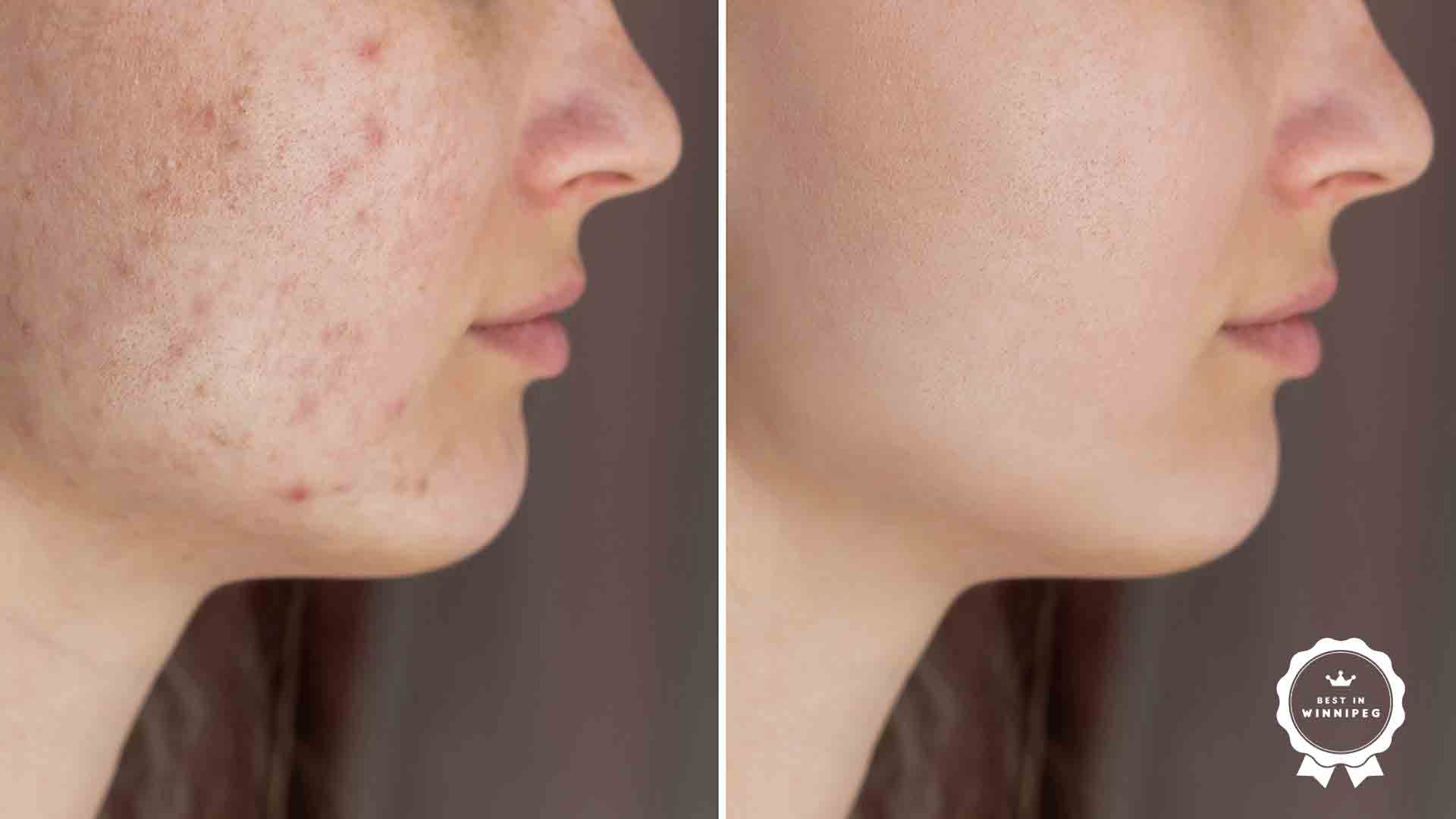 Acne Scars Causes and Treatment