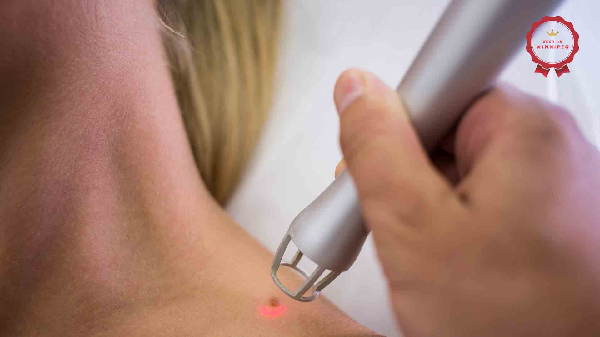 Best Mole Removal Services in Winnipeg