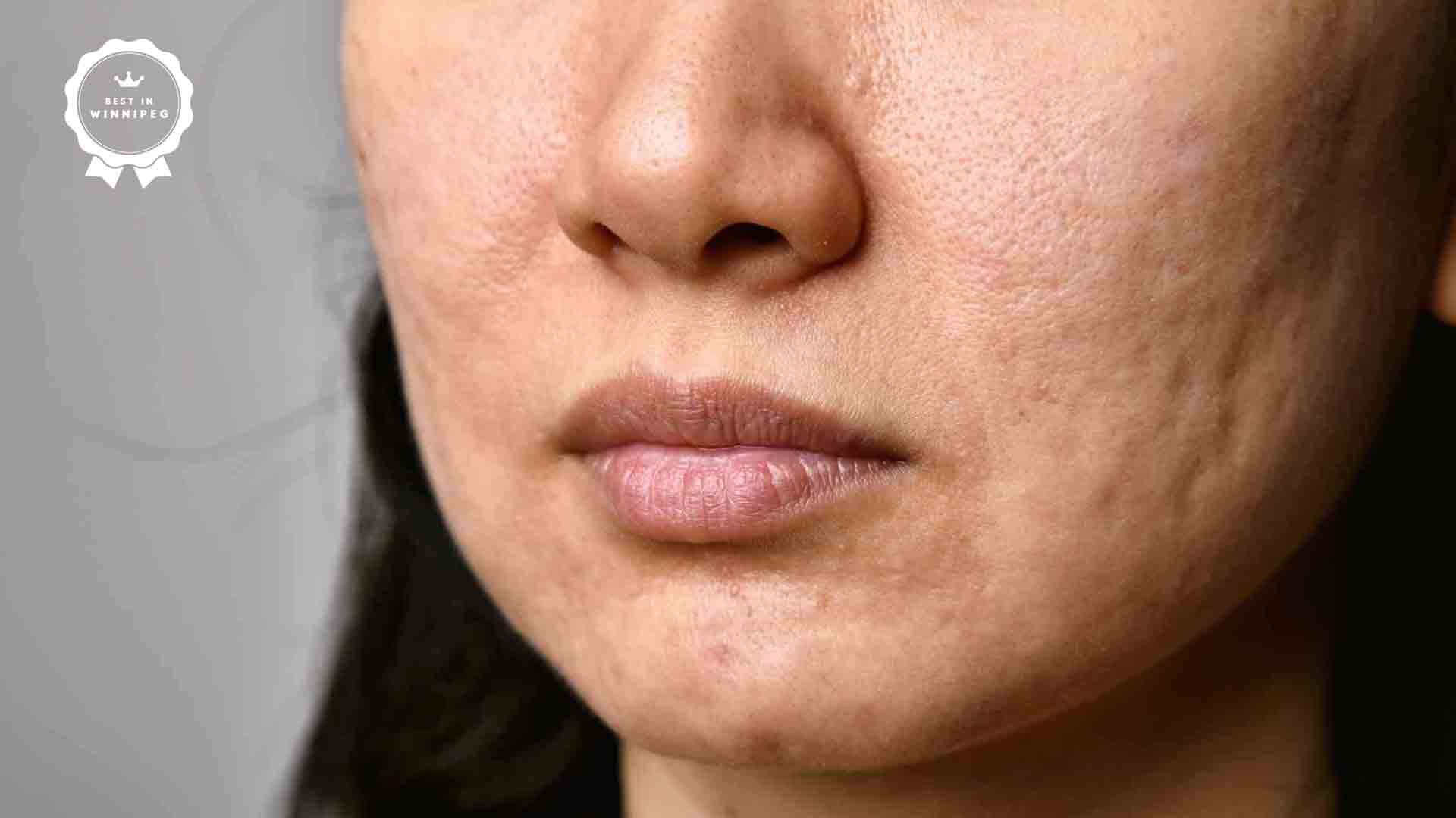 How Diet Affects Hormonal Acne