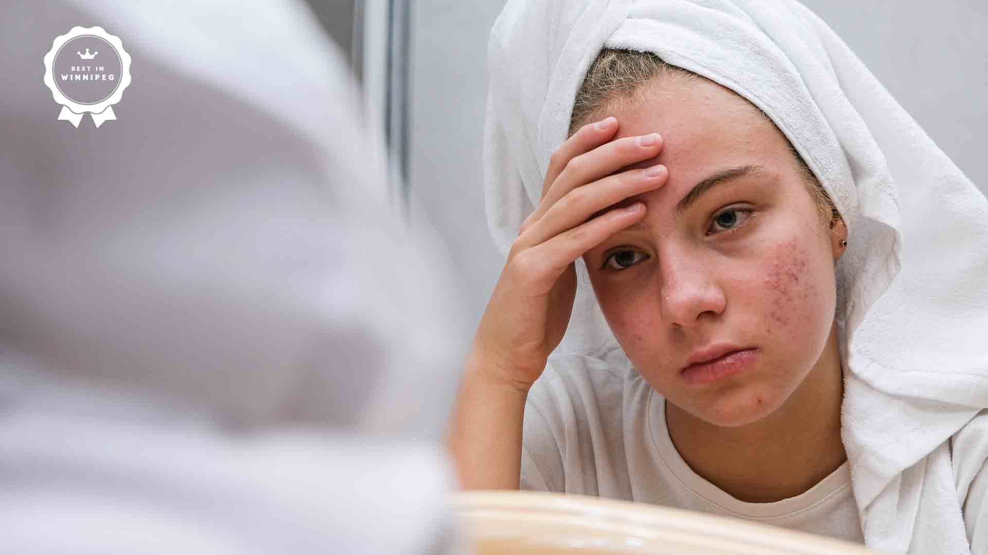 Stress Acne Causes and Treatment