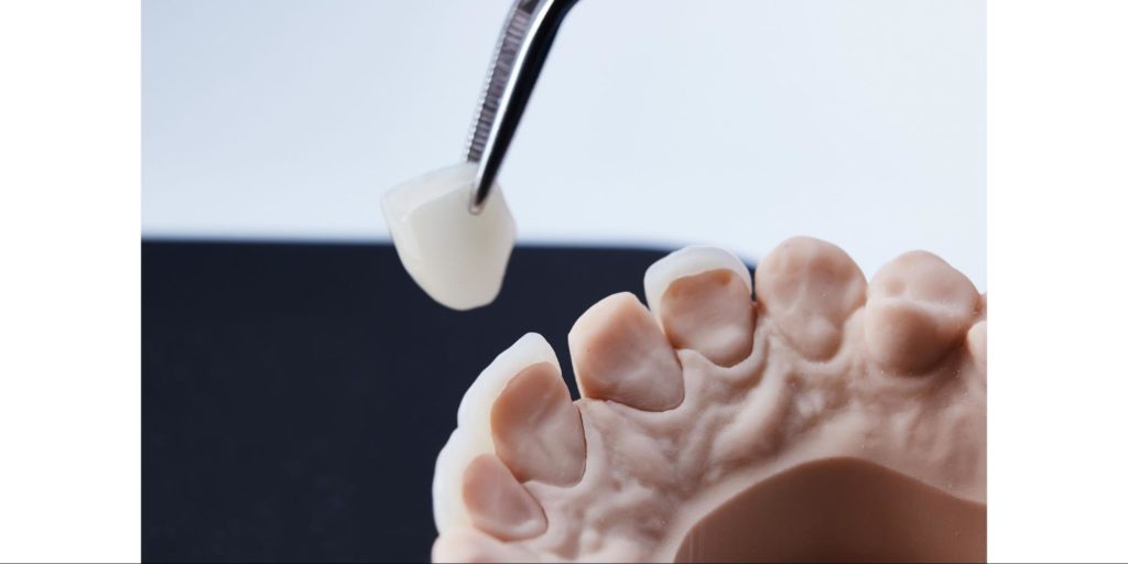 Veneers