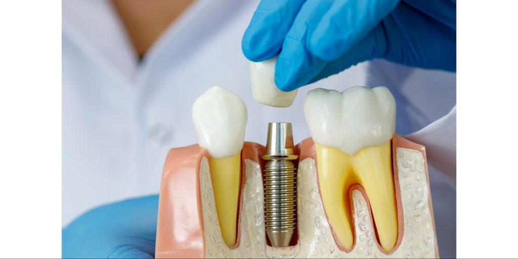 What are the most common dental implant problems