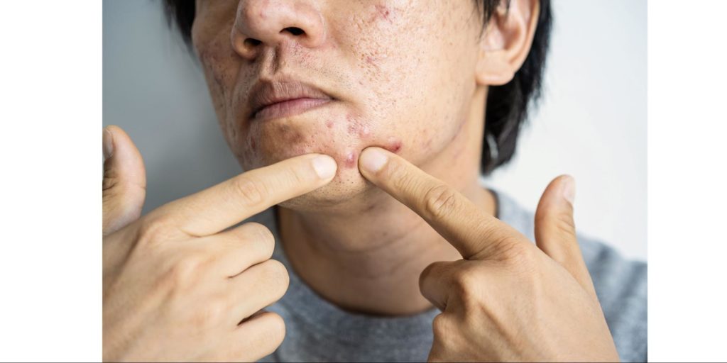 What is hormonal acne