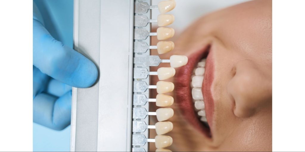 What is the procedure for getting dental veneers