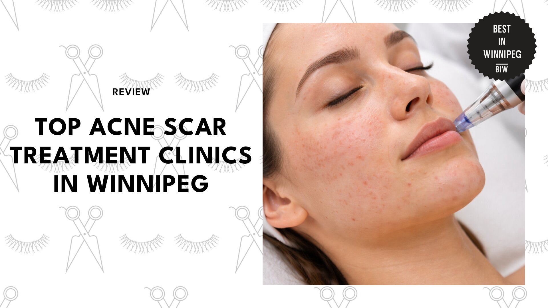 top-acne-scar-treatment-winnipeg-banner